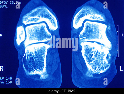 SPRUNGGELENK ARTHROSE, MRT Stockfoto