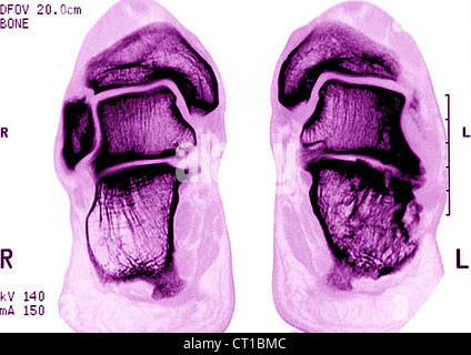 SPRUNGGELENK ARTHROSE, MRT Stockfoto