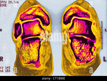 SPRUNGGELENK ARTHROSE, MRT Stockfoto