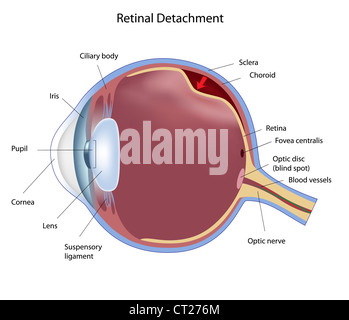 Auge Krankheit Netzhautablösung Stockfoto