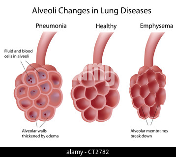Alveolen und Lungenerkrankungen Stockfoto