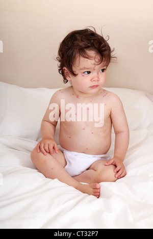 Baby mit Windpocken Ausschlag leiden Stockfoto