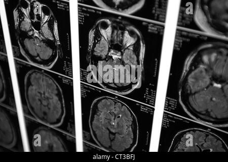 Eine Reihe von Kopf CT (Computertomographie) Scans von einem jungen Mann. Stockfoto