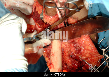 Chirurgen durchschneiden das Femur. Das Ende des Oberschenkelknochens wird geraspelt werden, runden es ab und verhindern Schäden an den Muskel-klappen. Stockfoto