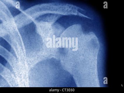 TUBERKULOSE IN DEN KNOCHEN, RÖNTGEN Stockfoto