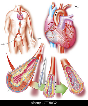 ARTERIELLE ANGIOPLASTIE, ABBILDUNG. Stockfoto