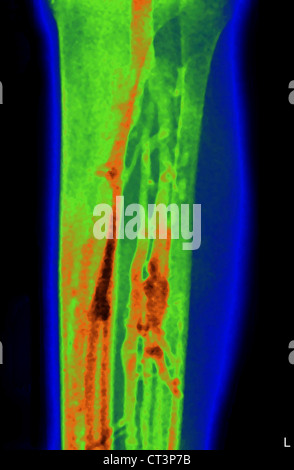 UNTERE EXTREMITÄT, ANGIOGRAPHIE Stockfoto