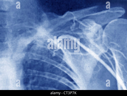 THOMBOSED VENE, ANGIOGRAPHIE Stockfoto