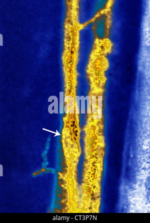 THOMBOSED VENE, ANGIOGRAPHIE Stockfoto