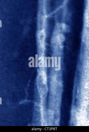 THOMBOSED VENE, ANGIOGRAPHIE Stockfoto