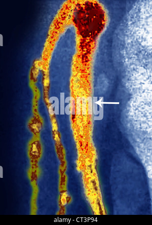 THOMBOSED VENE, ANGIOGRAPHIE Stockfoto