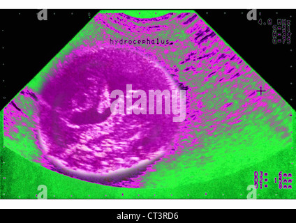 SONOGRAPHIE DES HYDROCEPHALUS Stockfoto