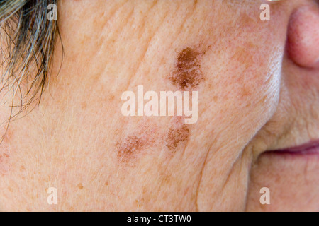 DERMATOLOGIE, BEHANDLUNG VON ÄLTEREN P. Stockfoto