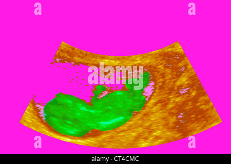 ULTRASCHALL BIOMETRIE DES FÖTUS Stockfoto