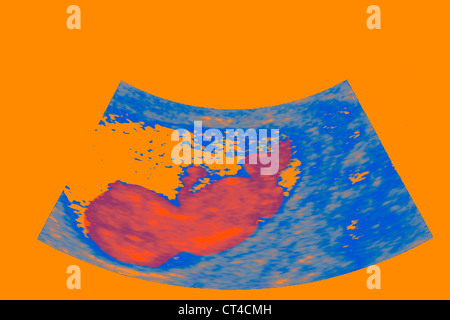 ULTRASCHALL BIOMETRIE DES FÖTUS Stockfoto