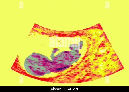 ULTRASCHALL BIOMETRIE DES FÖTUS Stockfoto