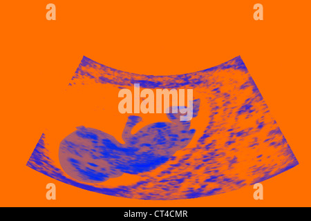 ULTRASCHALL BIOMETRIE DES FÖTUS Stockfoto