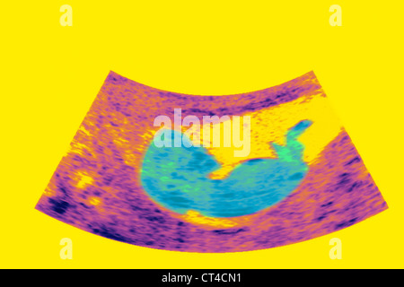 ULTRASCHALL BIOMETRIE DES FÖTUS Stockfoto