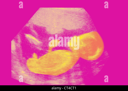 ULTRASCHALL BIOMETRIE DES FÖTUS Stockfoto