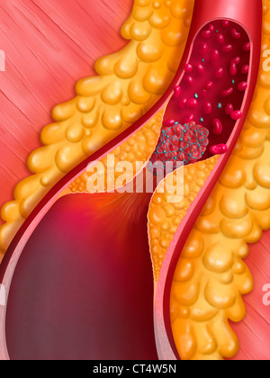 ARTERIELLE THROMBOSE, ZEICHNUNG Stockfoto