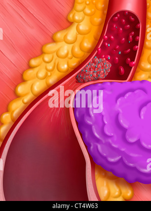 ARTERIELLE THROMBOSE, ZEICHNUNG Stockfoto