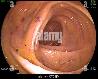 ANGIOM DES DICKDARMS, ENDOSKOPIE Stockfoto