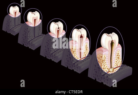 DENTAL CARIE, ZEICHNUNG Stockfoto