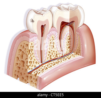 DENTAL CARIE, ZEICHNUNG Stockfoto