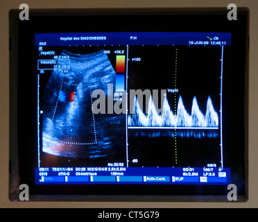 ULTRASCHALL BIOMETRIE DES FÖTUS Stockfoto