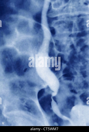 HARNLEITER TUMOR, X-RAY Stockfoto