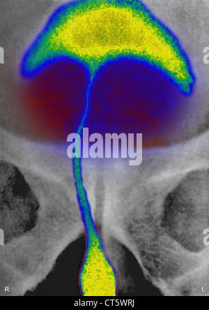 PROSTATA-ADENOM, X-RAY Stockfoto