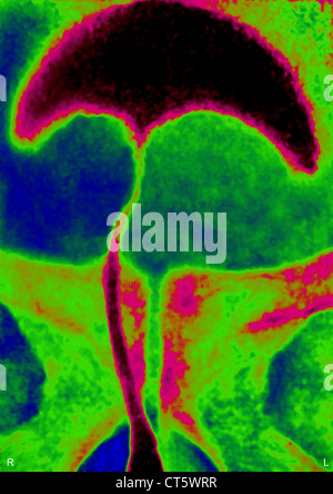 PROSTATA-ADENOM, X-RAY Stockfoto