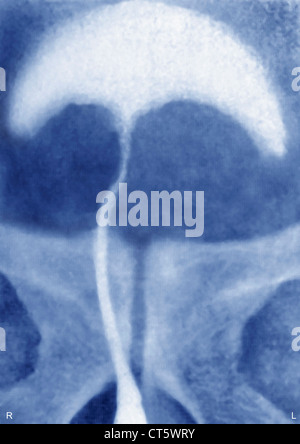 PROSTATA-ADENOM, X-RAY Stockfoto