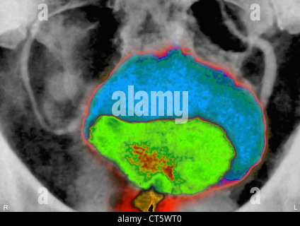 PROSTATA-ADENOM, X-RAY Stockfoto