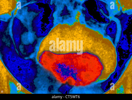 PROSTATA-ADENOM, X-RAY Stockfoto