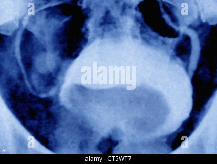 PROSTATA-ADENOM, X-RAY Stockfoto