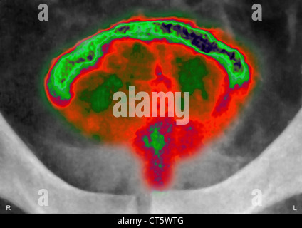 PROSTATA-ADENOM, X-RAY Stockfoto