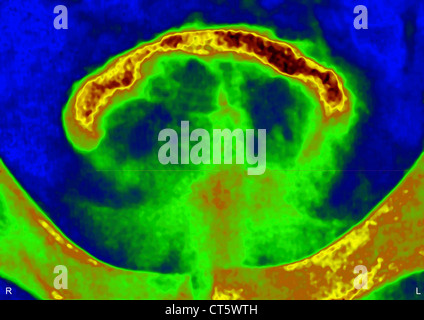 PROSTATA-ADENOM, X-RAY Stockfoto