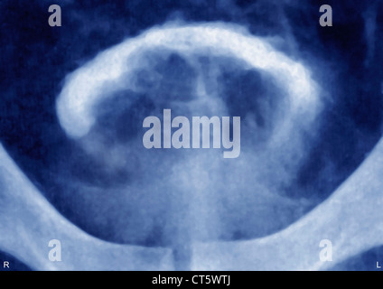 PROSTATA-ADENOM, X-RAY Stockfoto