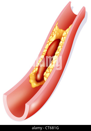 ARTERIELLE THROMBOSE, ZEICHNUNG Stockfoto