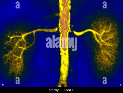 STENOSE DER LINKEN NIERENARTERIE Stockfoto