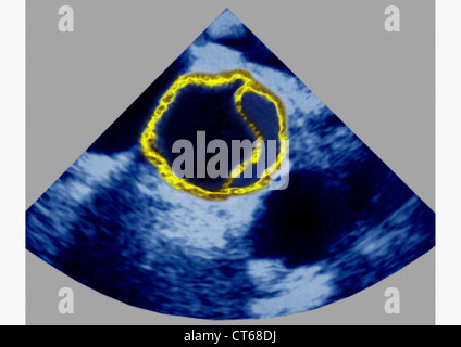 SEZIERT AORTA, SONOGR. Stockfoto