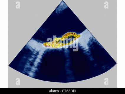 ATHEROMATOUS AORTA, SONOGRAPHIE Stockfoto