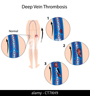 Tiefe Venenthrombose Stockfoto