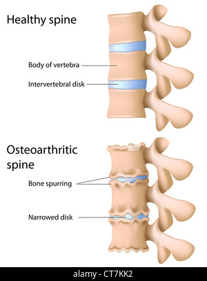 Arthrose der Wirbelsäule Stockfoto