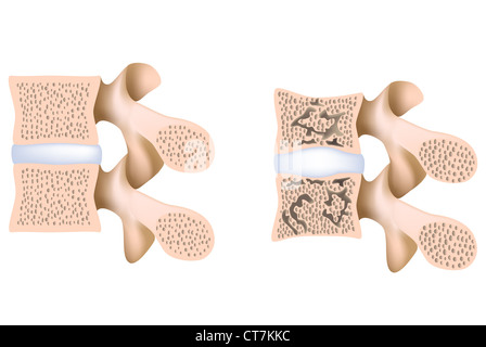 Lendenwirbelsäule Osteoporose Stockfoto