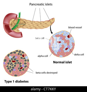 Normalen Pankreas Inselchen und Typ-1-Diabetiker Stockfoto