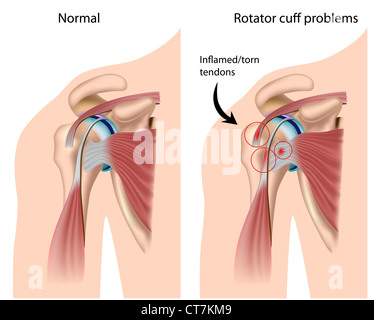 Schulter Impingement Stockfoto
