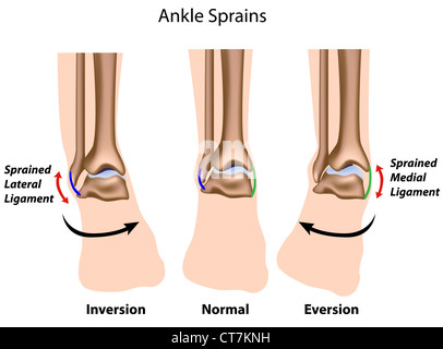Arten von Knöchel-Verstauchungen Stockfoto
