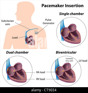 Herzschrittmacher-einfügen-Operation Stockfoto
